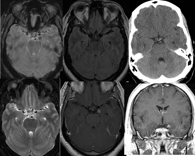 telangiectasia